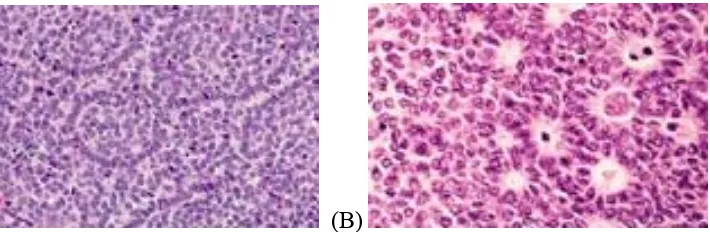 Gambar 29 A dan B. 29A.Gambaran mikroskopis dari tumor sel granulose. Pada gambar 29B dapat dilihat Call-Exner Bodies (dikutip dari Rosai J