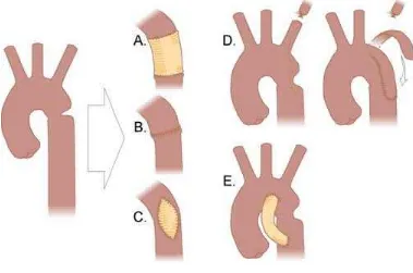 Gambar 3. Penatalaksanaan bedah koartasio aorta.12 