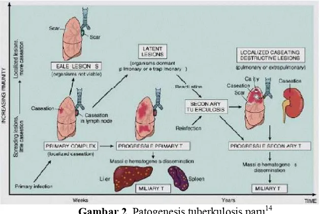 Gambar 2. Patogenesis tuberkulosis paru14 