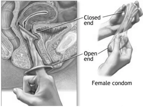 Gambar 2.4 Kondom Polyurethane untuk Wanita 