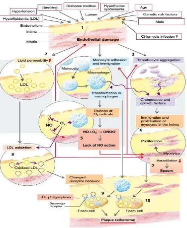Gambar 2. Response to Injury Hypothesis of Atherosclerosis Genesis 