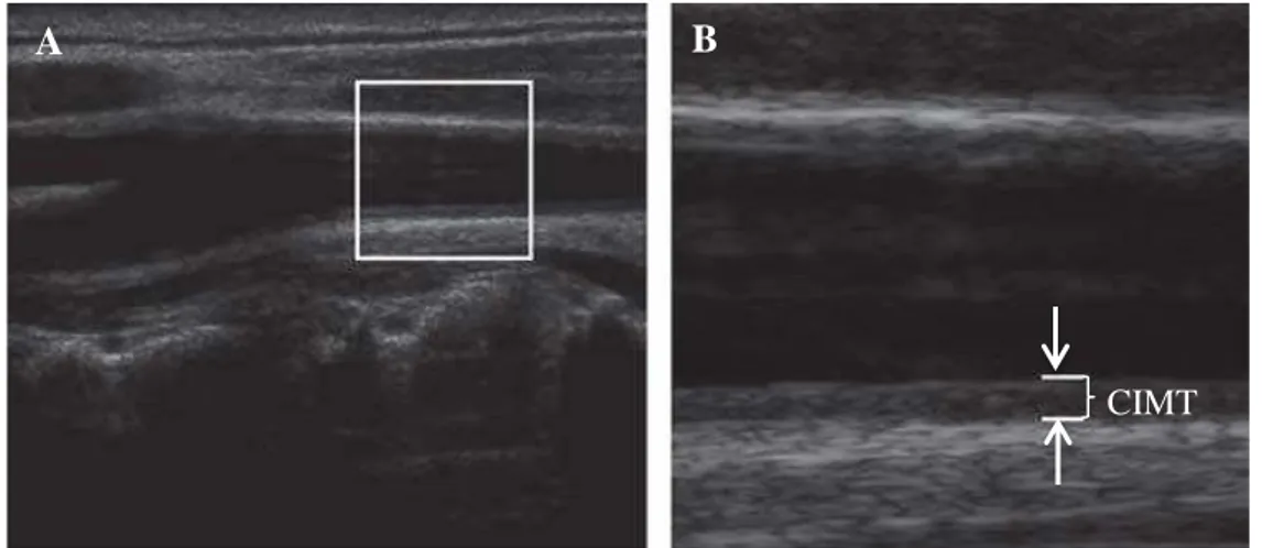Gambar 5. (A) Pencitraan dinding arteri karotis komunis dengan ultrasound  vaskular B-mode