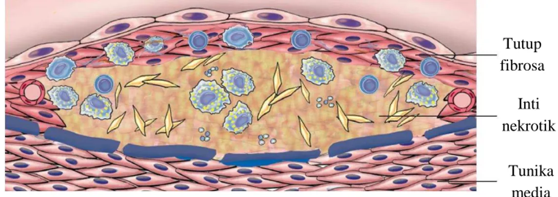 Gambar 2. Struktur aterosklerosis. 18 2.1.4.   Patogenesis aterosklerosis