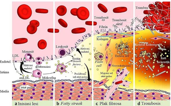 Gambar 3. Patogenesis aterosklerosis. 20