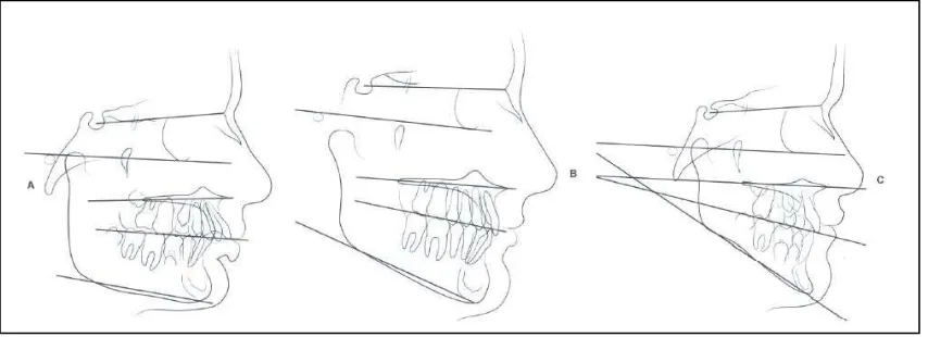 Gambar 2.2. Tracing sefalogram menurut Sassouni. A. Tracing sefalogram tinggi wajah anterior bawah menurut Sassouni yang pendek