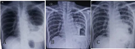 Figure 1. Chest X-ray of the Patent Before Pleuroscopy (A), Afer Pleuroscopy (B), and Afer Pleurodesis (C) 