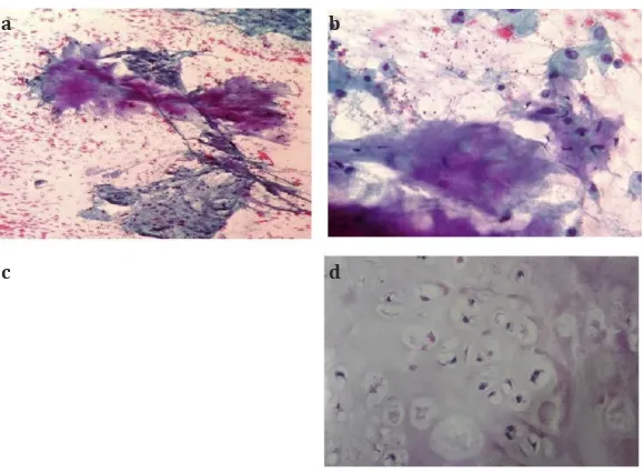 Gambar 3. (a dan b) Gambaran histopatologi kondrosarkoma pada pasien, (c(d)(c)  dan d) Gambaran histopatologi kondrosarkoma (sumber: Appleton & Lange