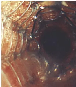 Gambar 3. Jenis-Jenis Stent. a) Dumon Stent; b) Polyflex2  Stent; c) Noppen Stent; d) Covered Ultraflex Stent; e) Alveolus  Areo Stent; f) Wall Stent; g) Mandel and Rupp Bronchial Stent; h) Montgomery T-Stent; i) Bifurcated Dumon Stent; j) Dynamic Stent; and k) Micro-tech Bifurcaton Stent 