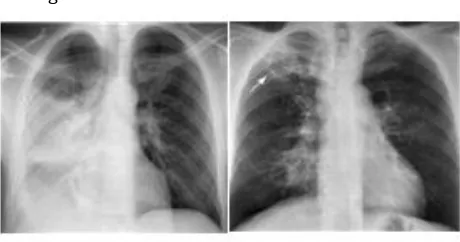 Gambar 6. Gambaran Foto Toraks pada Tuberkulosis 