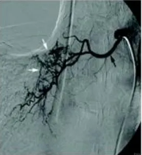 Gambar 4. Angiografi pada pria 54 tahun. Dapat dilihat ada hipervaskularisasi pada panah putih.31 