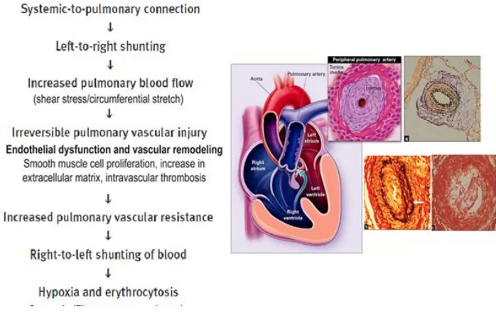 Gambar 5. Patofisiologi sindroma Eisenmenger9 