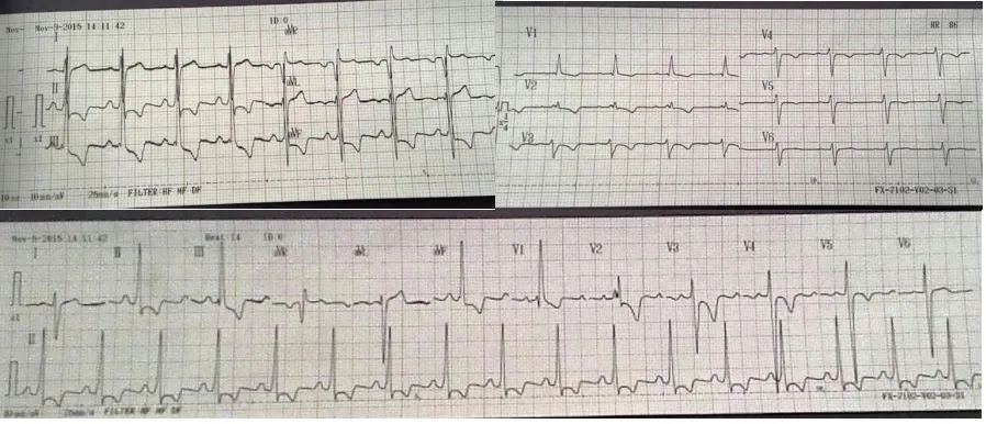 Gambar 1. Hasil EKG pasien didapatkan irama sinus, HR 86x/menit, deviationR/S di V1 > 1 dan didapatkan RV , gelombang P normal, interval PR 0,16 s, kompleks QRS 0,08 s, interval QT 0,36 s, right axis strain di lead II,III,aVF,V1-5 mengesankan adanya dilatasi ventrikel kanan    