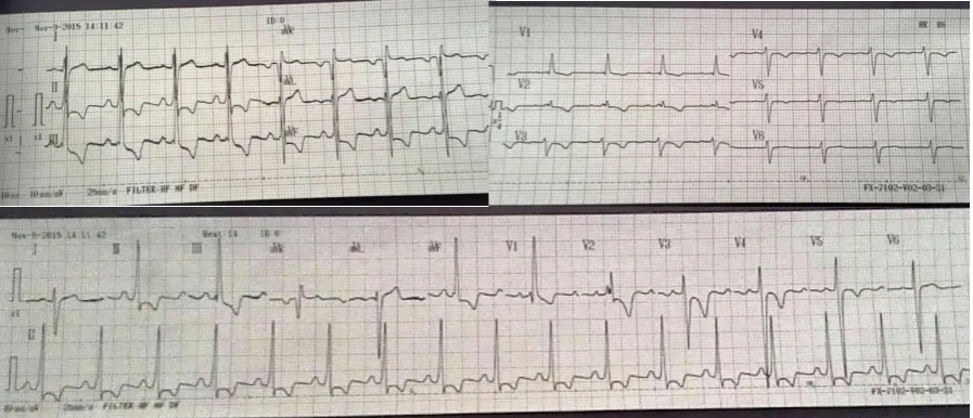 Gambar 1. Hasil EKG pasien didapatkan irama sinus, HR 86x/menit, deviationR/S di V1 > 1 dan didapatkan RV , gelombang P normal, interval PR 0,16 s, kompleks QRS 0,08 s, interval QT 0,36 s, right axis strain di lead II,III,aVF,V1-5 mengesankan adanya dilatasi ventrikel kanan    
