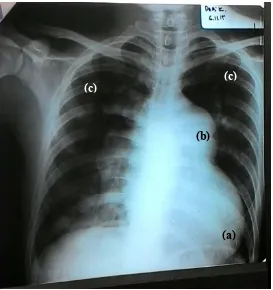 Gambar 2. Hasil X-Foto Thorax PA didapatkan gambaran pembesaran jantung dengan pruning (a)apexrounded (CTR 65%), (b)conus pulmonalis menonjol, dan didapatkan (c) gambaran pembuluh darah pulmonal perifer.Kesan dilatasi ventrikel kanan disertai hipertensi pulmonal 