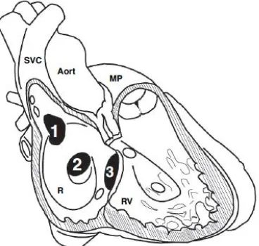 Gambar 4.  superior vena cava Tipe dan lokasi tipikal ASD. (1) ASD sinus venosus pada pertemuan antara (SVC) dan right atrium (RA); (2) ASD sekundum; (3) ASD primum/ tipe kanal AV