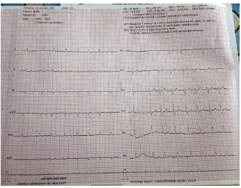 Fig. 1. Pre Treatment ECG 
