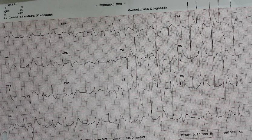 Fig 1. Patient’s ECG 