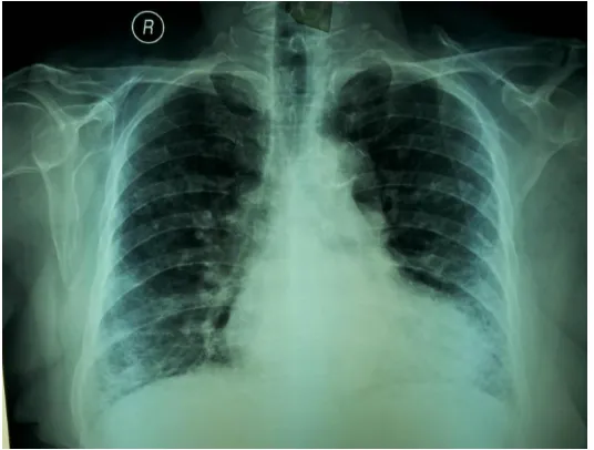Figure 1. Chest radiography showing with aortic calcification and reticular infiltrates in both lungs 