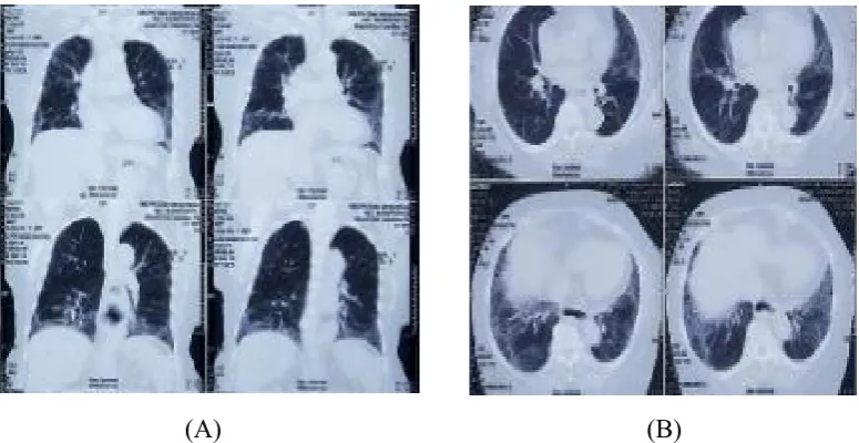 Figure 2. High resolution computed tomography (HRCT) scan of the chest showed graound glass appearance in (A)