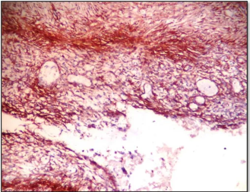 Gambar 2. Sel-sel stroma endometrium terlihat positif dengan CD 10 dengan  intensitas kuat  dan difus