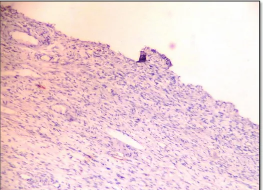 Gambar  5.  Jaringan kista  coklat  ovarium  (klinis)  tanpa  pelapis  epitel,  tanpa  sel-sel  stroma  endometrium  maupun  sel  makrofage  hemosiderin  laden,  tidak  terwarnai  coklat  dengan  CD  10  sehingga  ekspresinya  dinyatakan negative (x100)