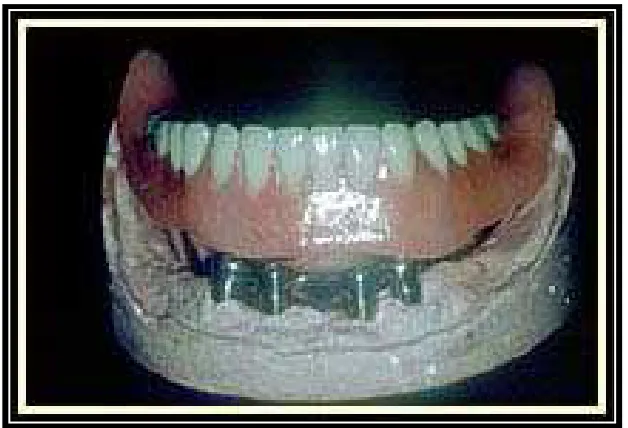 Gambar 5. Implan penyangga  overdenture. (http://colgate.com/app/colgate/us/oc/ implantsupporteddenture.cusp) (17 Oktober 2010)  