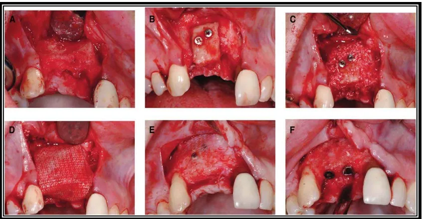 Gambar 13. Prosedur bone graftingpenutupan dengan membran. E) kondisi setelah 6 bulan pasca-operasi
