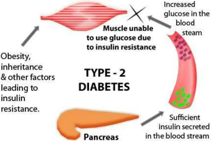 Gambar 2. Diabetes Melitus tipe 2 