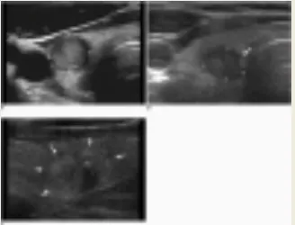 Gambar 4. Gambaran USG dari tepi nodul tiroid 