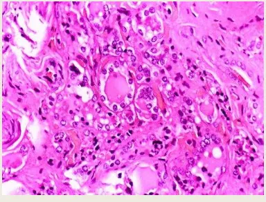 Gambar 10. Jaringan karsinoma tiroid folikuler Sumber: Santacroce L. Follicular Thyroid Carcinoma