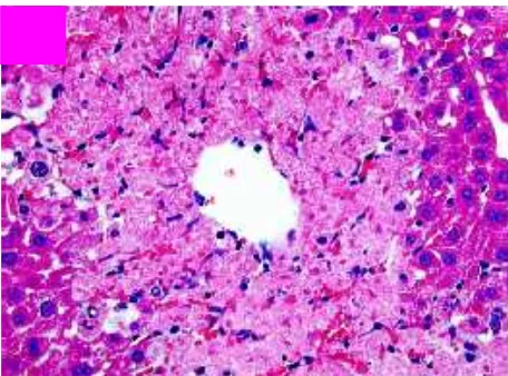 Gambar 7. Gambaran histopatologis hepar akibat keracunan asetaminofen   menunjukkan adanya gambaran nekrosis di sentrilobuler.31  