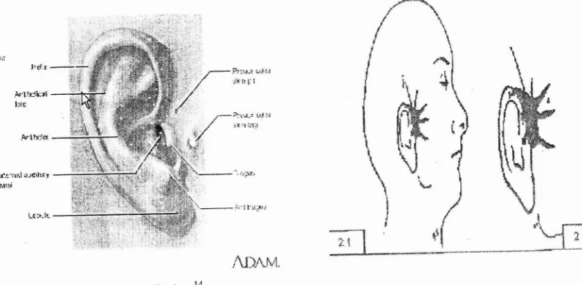 Gambar 2. Fistula Preaurikula 