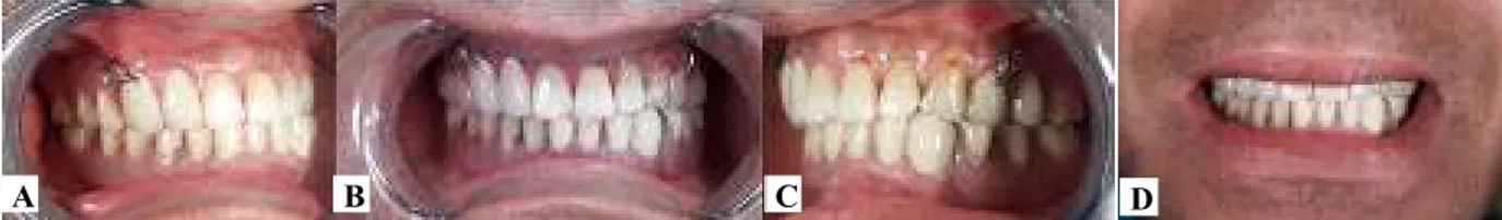 Gambar 10 Insersi gigi tiruan RA-RB A kanan, B depan, C kiri, D kontrol   