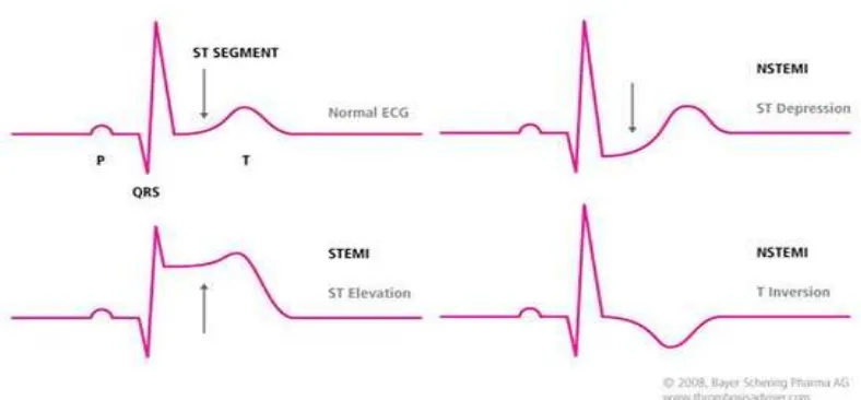 Gambar 4. Gambaran EKG STEMI dan NSTEMI28