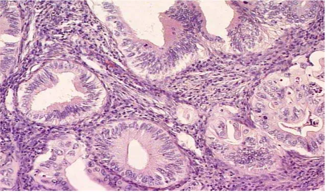 Gambar 2.6  Nonkeratinizing karsinoma sel skuamosa invasif (histologi). (Cervical Cytology, Leonardo da Vinci, 2013)