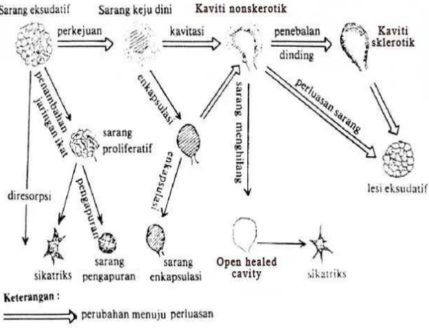 Gambar 3 Skema patogenesis infeksi Tb paru post primer