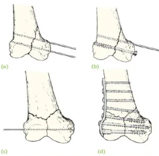 Gambar 12. Lag screw sederhana