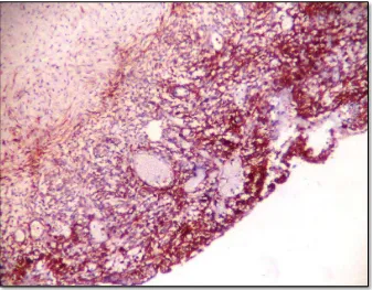 Gambar 1. Sediaan kista endometriosis secara konkordan terwarnai positif pada sel-sel stroma  kista ovarium(x100)