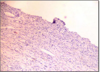 Gambar 5. Jaringan kista coklat ovarium (klinis) tanpa pelapis epitel, tanpa sel-sel stroma endometrium maupun sel makrofage hemosiderin laden, tidak terwarnai coklat dengan CD 10 sehingga ekspresinya dinyatakan negative (x100)