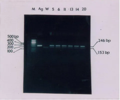 Figure 2The gel electrophoresis from PCR product to amplified of EBVcancer with HPV positive samples1 (246 bps long) and and EBV2 (153 bps long) of EBV in cervical The gel electrophoresis from PCR product to amplified of EBV1 (246 bps long) and and EBV2 (153 bps long) of EBV in cervical cancer with HPV positive samples.