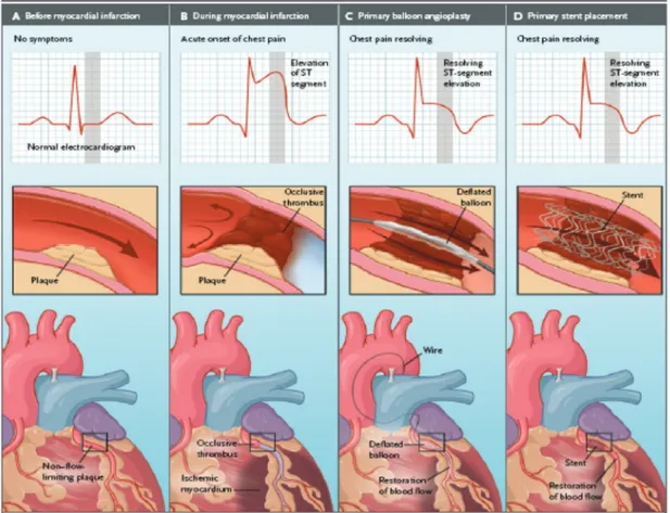 Gambar 1. Gejala klinis, gambaran EKG dan gambaran anatomi saat dilakukan Intervensi Koroner  Perkutan Primer 1