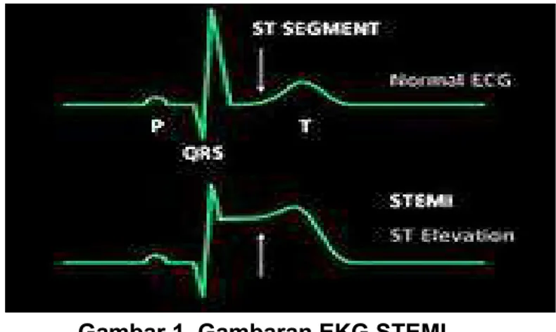 Gambar 1. Gambaran EKG STEMI Tabel 3. Lokasi Miokard Infark Berdasarkan Gambar EKG
