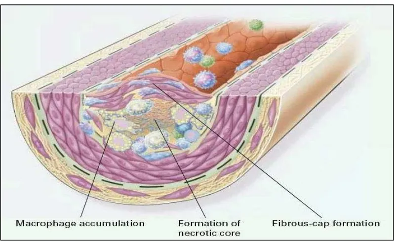 Gambar 3  : Pembentukan aterosklerosis lanjut  Sumber : Ross Russel. Atheroclerosis an inflammatory disease