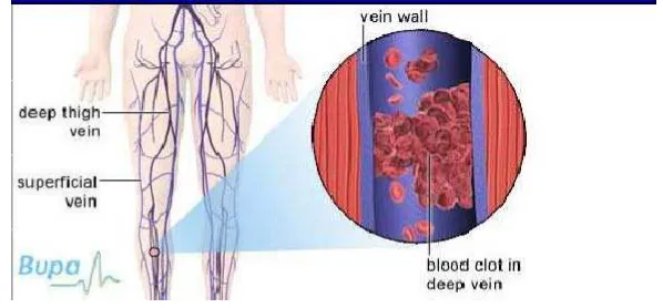 Gambar 3 gumpalan darah beku di vena dalam 