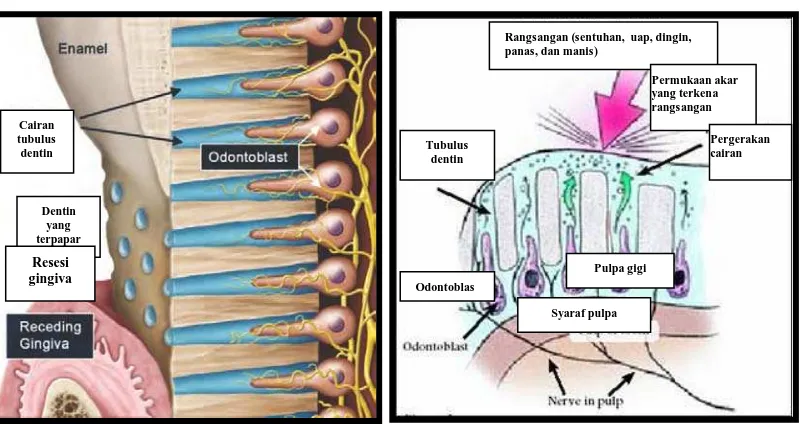 Gambar 5. Gambaran etiologi dan mekanisme terjadinya hipersensitif dentin (Strassler HE, Drisko CL, Alexander DC