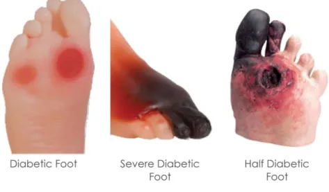 Gambar 1. Diabetic Foot 
