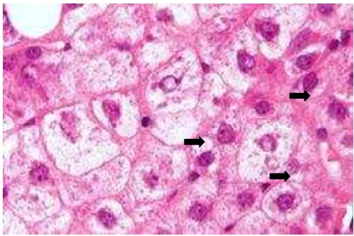 Gambar. 6. Histopatologi hepar akibat konsumsi asam lemak trans, dengan sel ballooning  dikutip dari Madiha D 1 