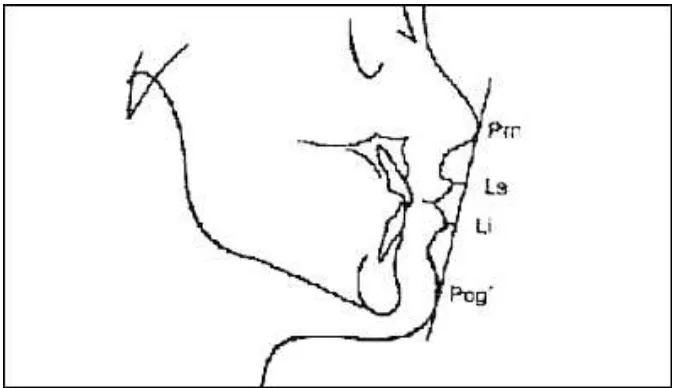 Gambar 8. Analisis jaringan lunak wajah menurut Ricketts (E line)24