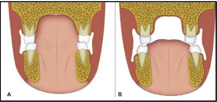 Gambar 2.4. A.Posisi lidah normal, B. Posisi lidah kebawah  sebagai kompensasi bernafas melaui mulut.10 