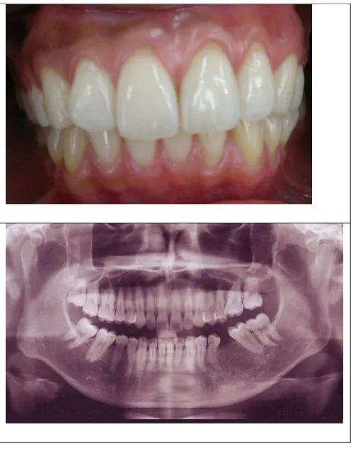 Gambar 1. Gambaran klinis sebelum perawatan, tampak resesi pada gigi 11,21,22 